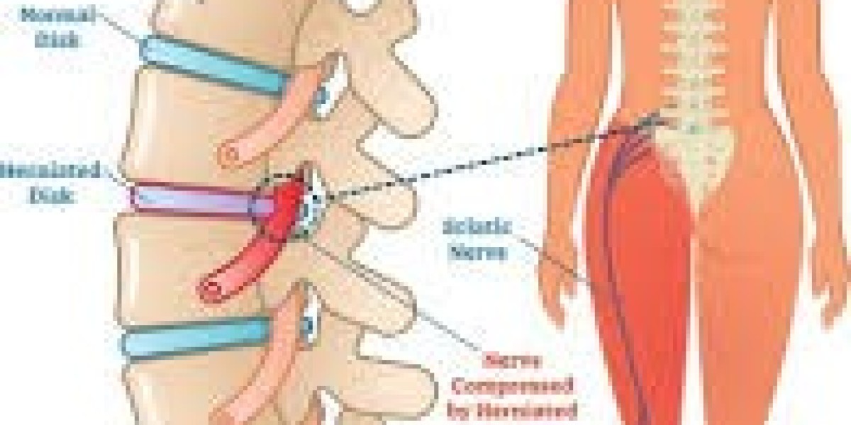 Can Gabapentin 300 mg Capsule Effectively Relieve Lower Back Sciatica Pain?