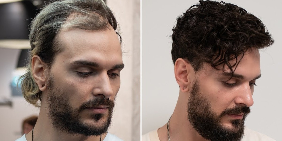 Hair Restoration in Beverly Hills: Advanced Solutions for Natural Results