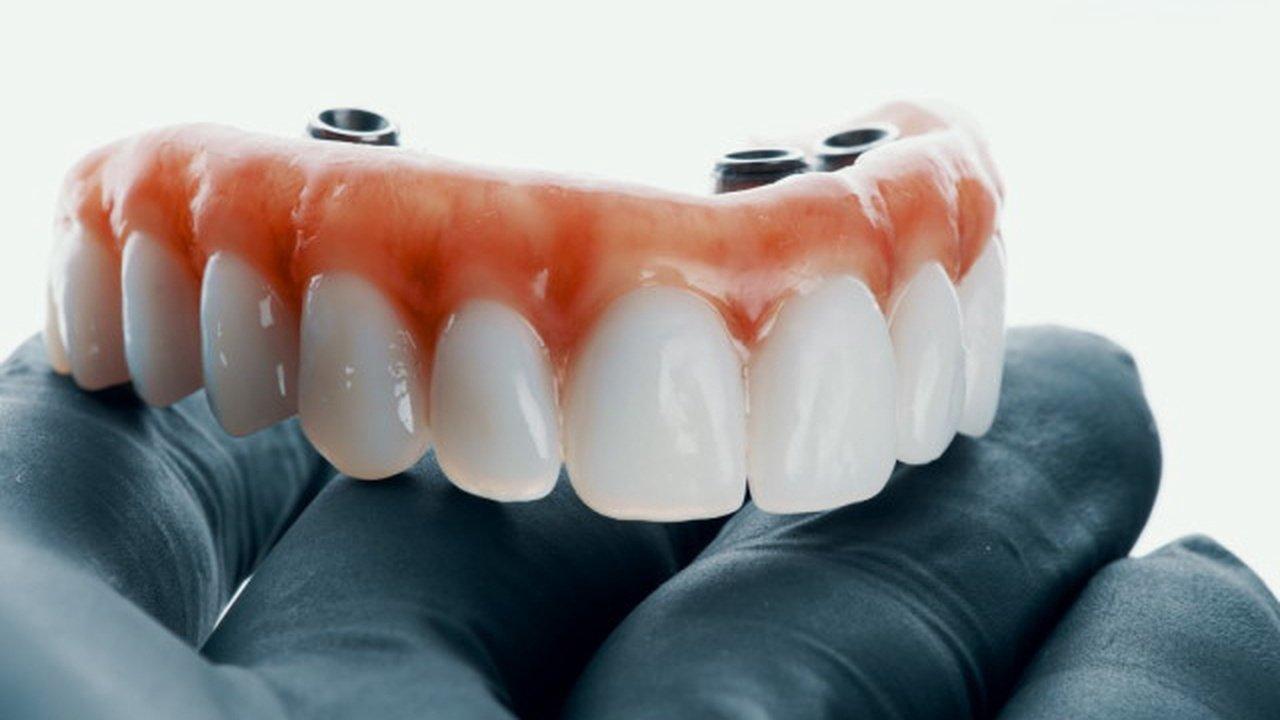 The Perfect Balance Between Dentures and Implant Stability | Articles | baluke | Gan Jing World - Technology for Humanity | Video & Movie Streaming