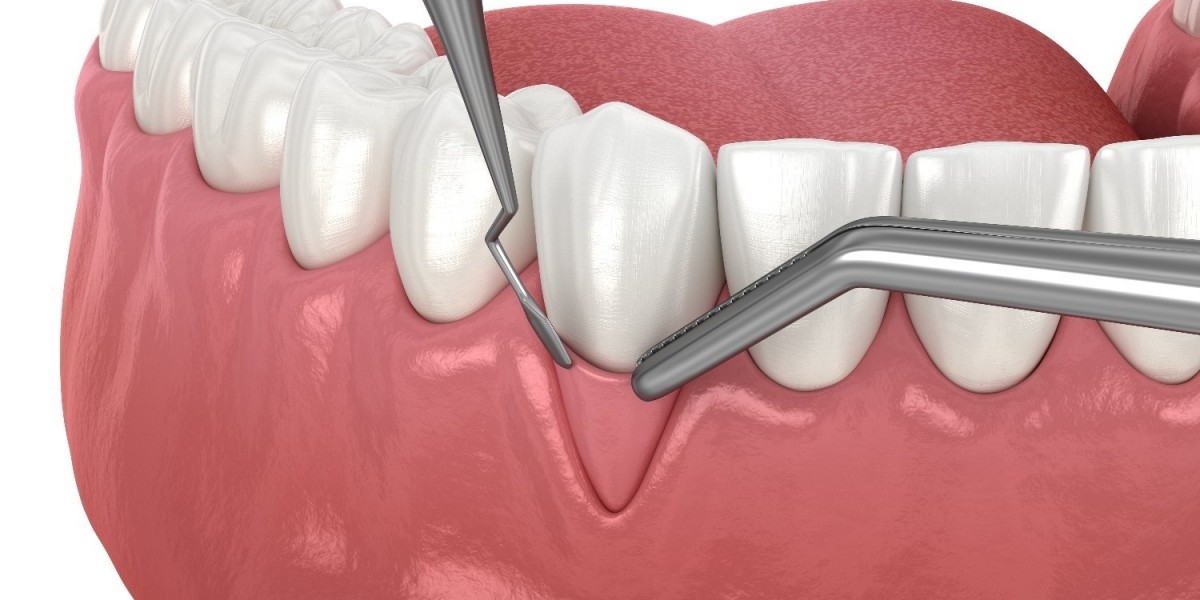 Recognising Gum Graft Failure: Causes and What to Do Next