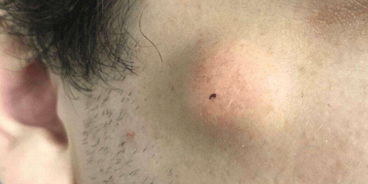 When Should You Get Cyst Drainage? Guide to Safe Treatment