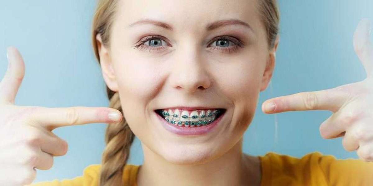 Are Dental Braces Worth It for Mild Misalignment?
