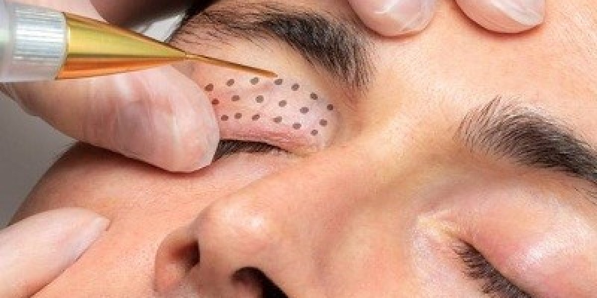 Achieve Youthful Glow Effortlessly with Plasma Pen Treatment