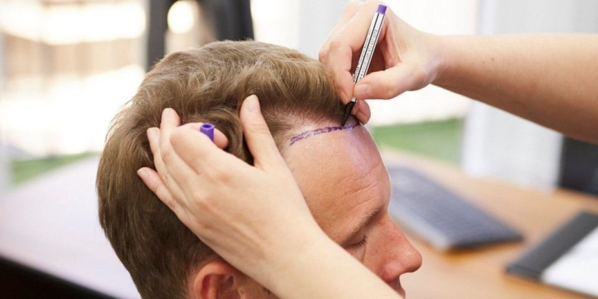 How Does Front Line Hair Fixing Restore a Natural Hairline?