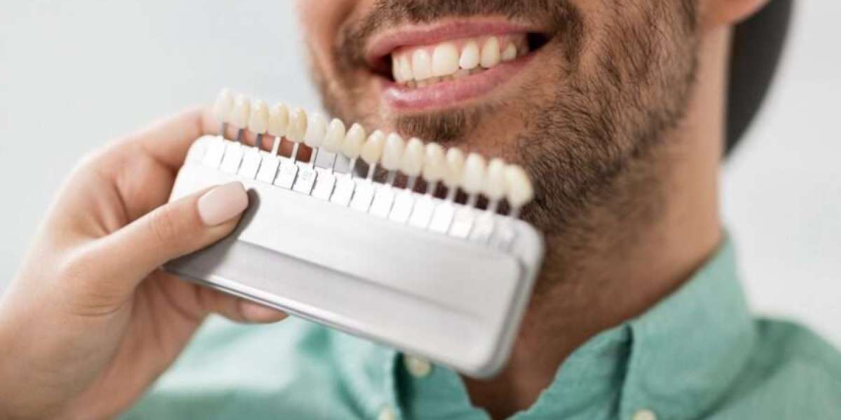 How Composite Veneers Enhance Your Smile Instantly