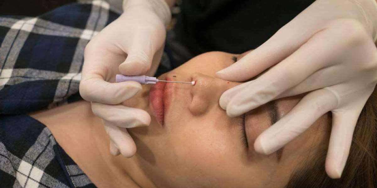 Hiko Nose Thread Lift: A Complete Beginner’s Guide