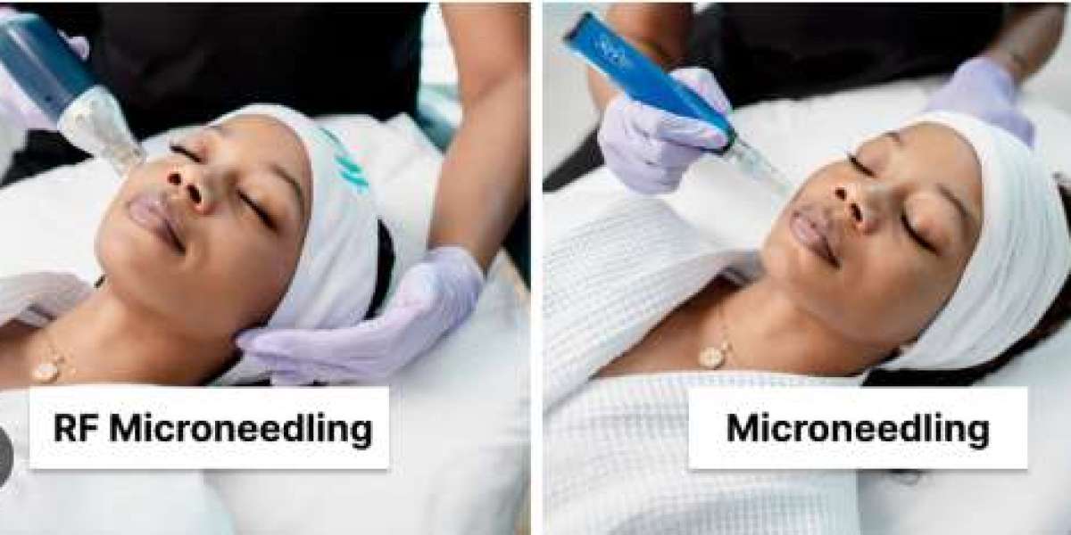 RF Microneedling: A Modern Solution for Skin Rejuvenation