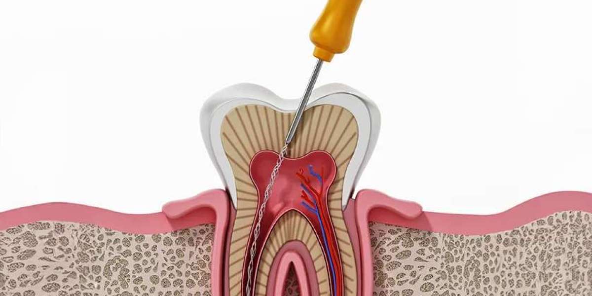 Step-by-Step Root Canal Treatment Process