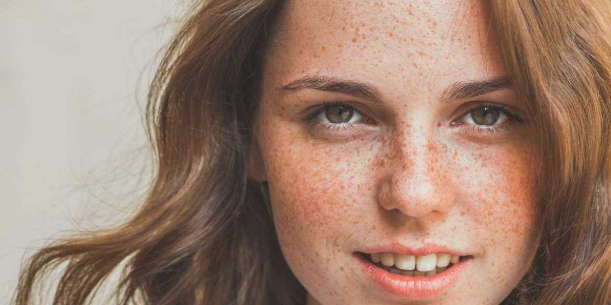 Freckles and Blemishes: What’s the Real Difference?