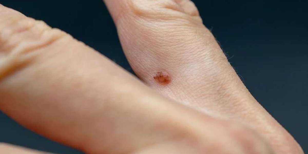 How Laser Warts Removal Treatment in Dubai Boosts Confidence?
