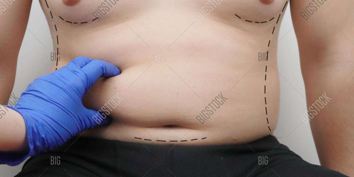 Tummy Tuck Surgery in Islamabad – Final Extended Simple Guide (Enfield Royal Clinic)