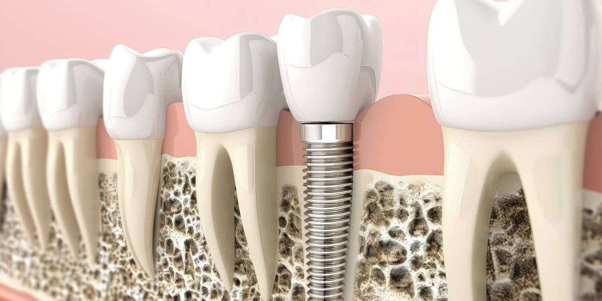 Dental Implant Cost In Dubai Same Day Implants Guide