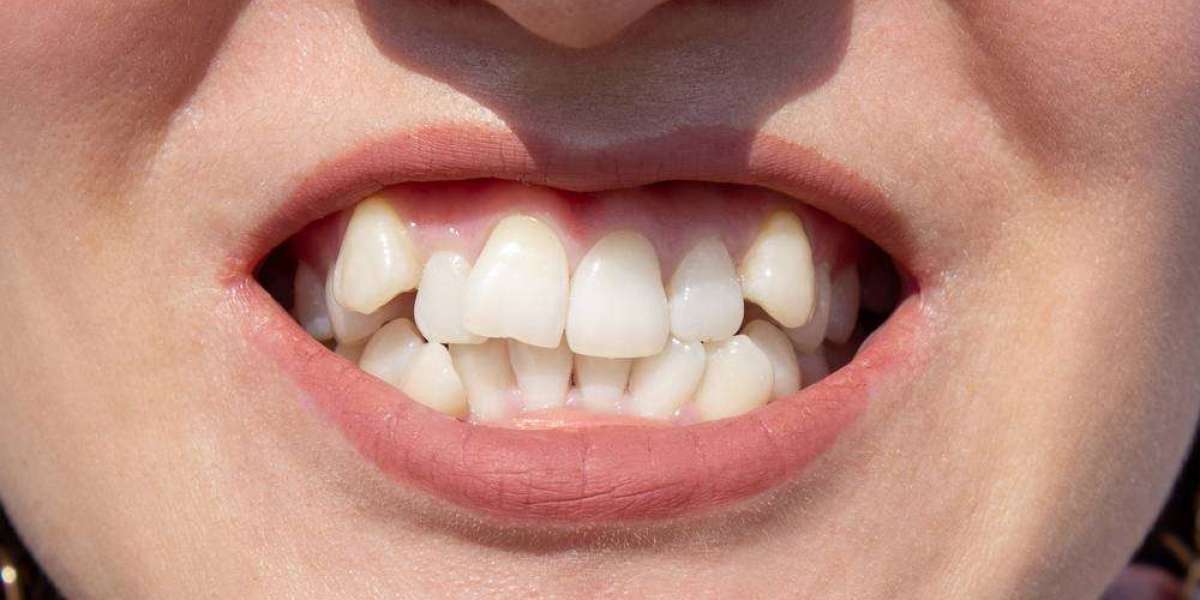 How to Choose the Best Crooked Teeth Treatment in Dubai?