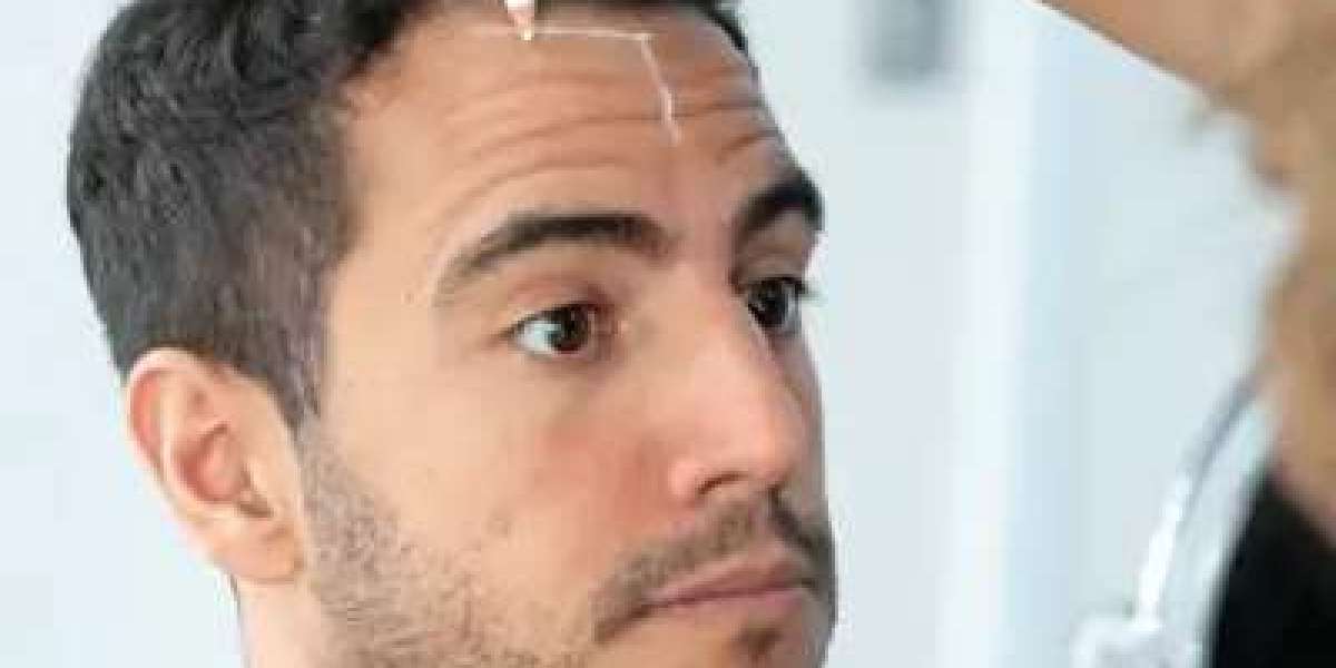 Hair Transplant Techniques Advanced Methods Explained