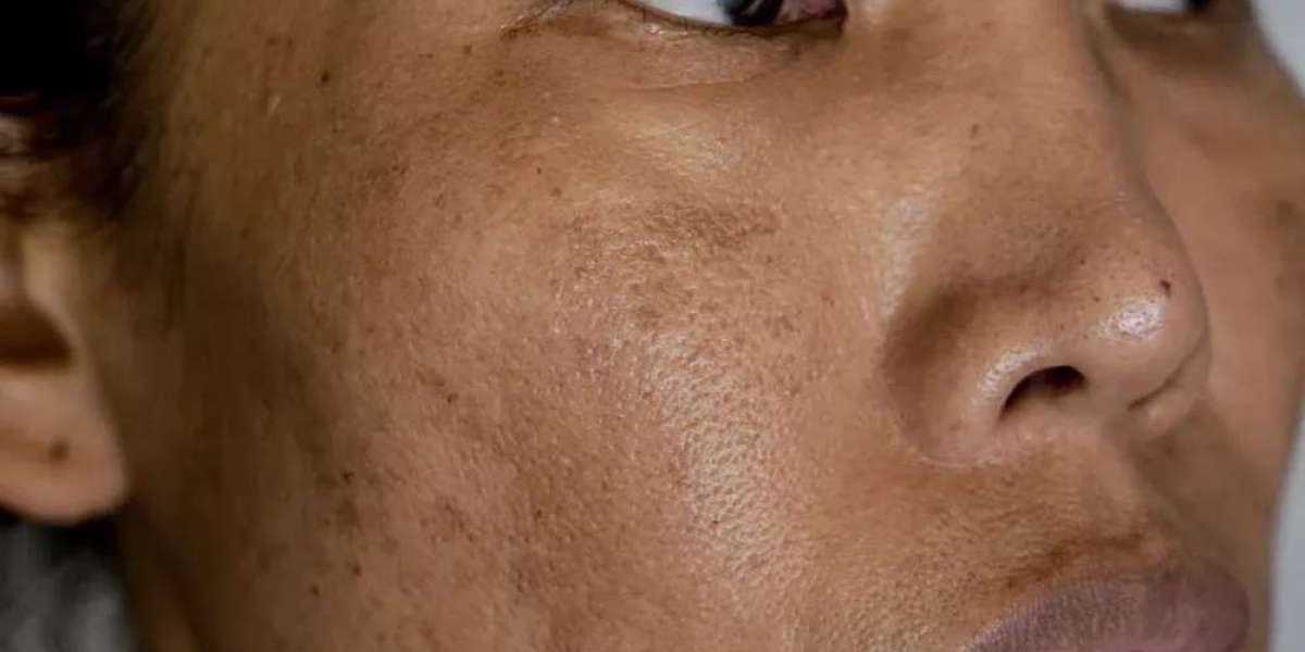 Understanding Melasma Treatment: Causes and Solutions