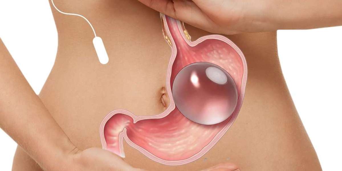 What makes Allurion Gastric Balloon Clinic enable powerful slimming results?