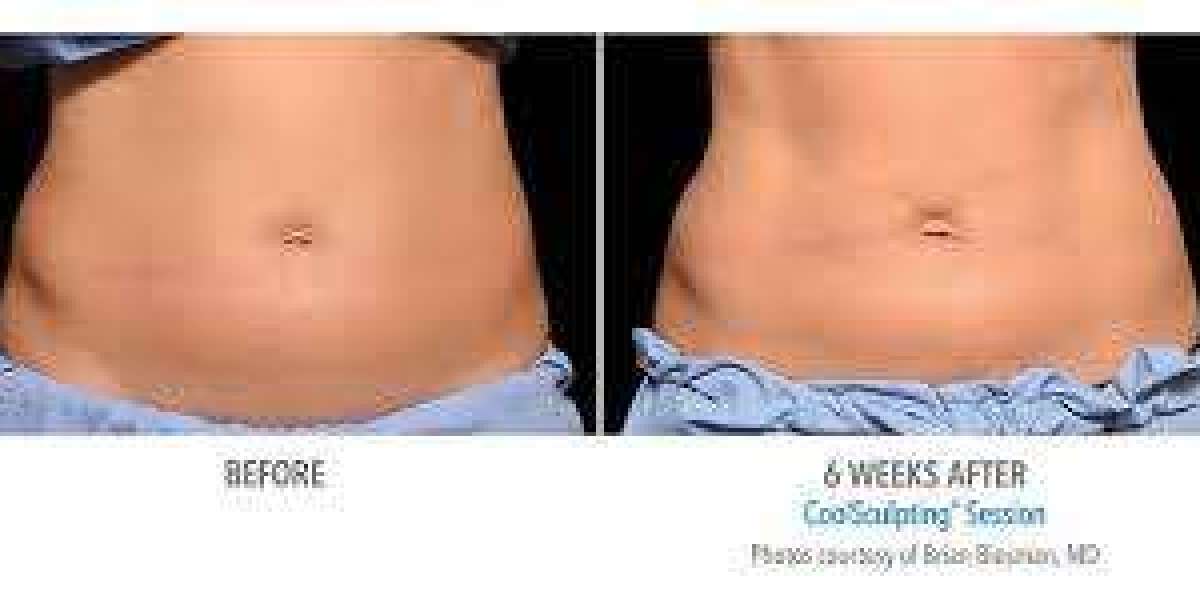 Body Sculpting Ottawa: A Modern Way to Shape Your Confidence