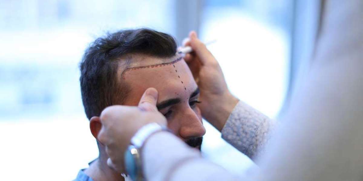 Hair Transplant Density Planning for Natural Appearance