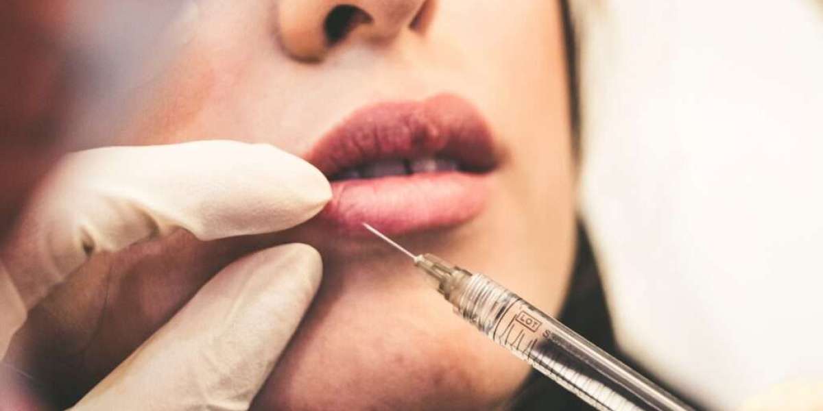 Best lip filler injections for subtle enhancement without overfilling