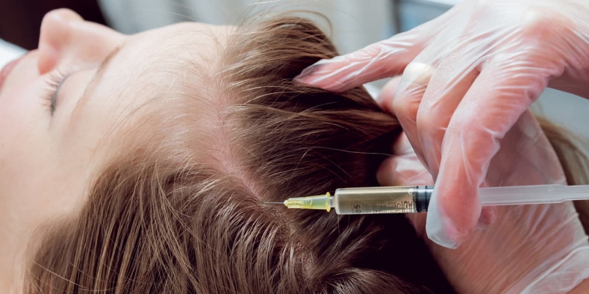 PRP Hair Treatment for Fuller-Looking Hair Naturally
