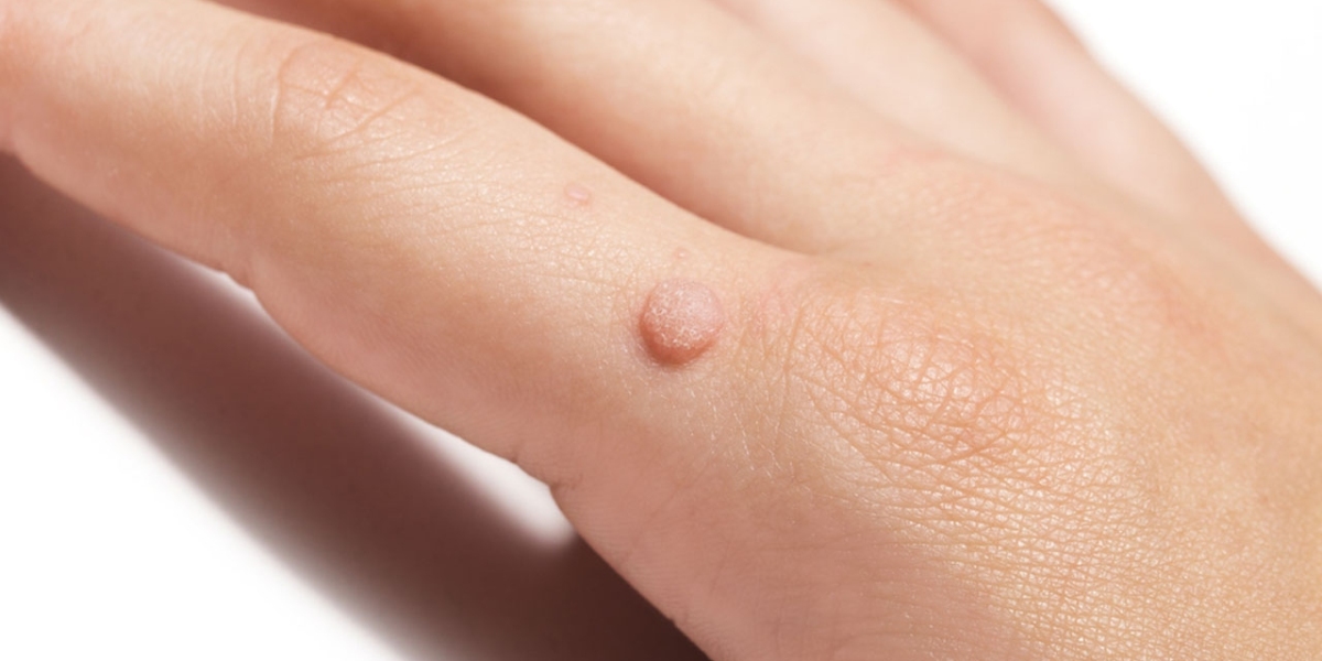 How Effective Is Laser Wart Removal for Facial Warts in Dubai?