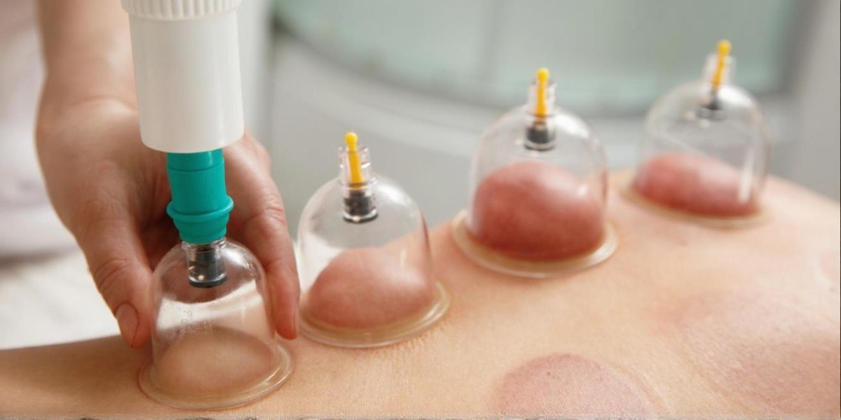 Unlock Natural Wellness Hijama Cupping Therapy for Deep Relief