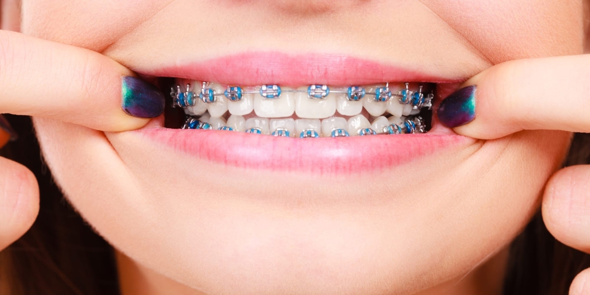 Ultimate Shine Smile Boost Driven With Dental Braces Energy Lift