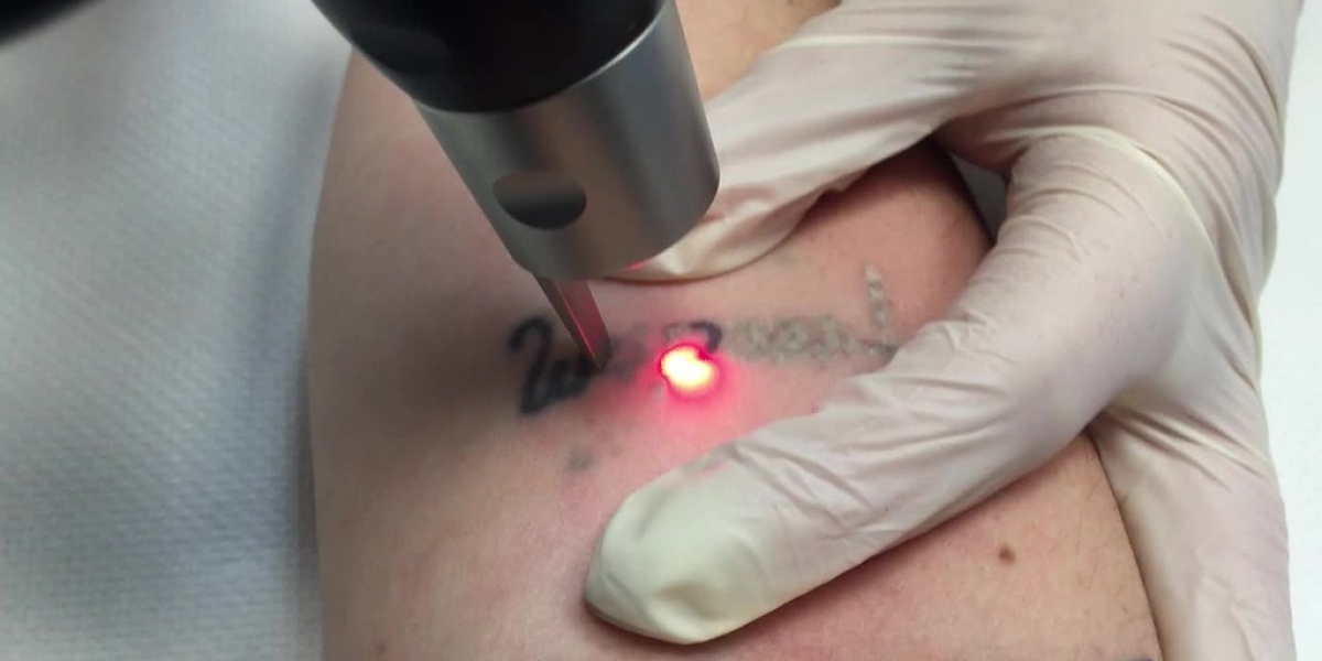 Picosure Tattoo Removal Glow Surge Laser Ink Erase Energy Flow