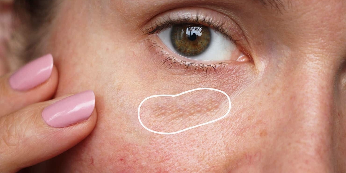 Milia Treatment in Dubai silky smooth skin boost fresh luminous look