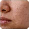 Dull/Congested Skin Treatment Dandenong, Dandenong North