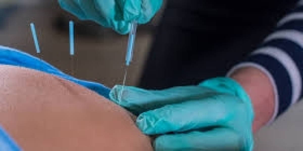 Dry Needling And Physiotherapy Gloucester A Practical Guide To Better Movement