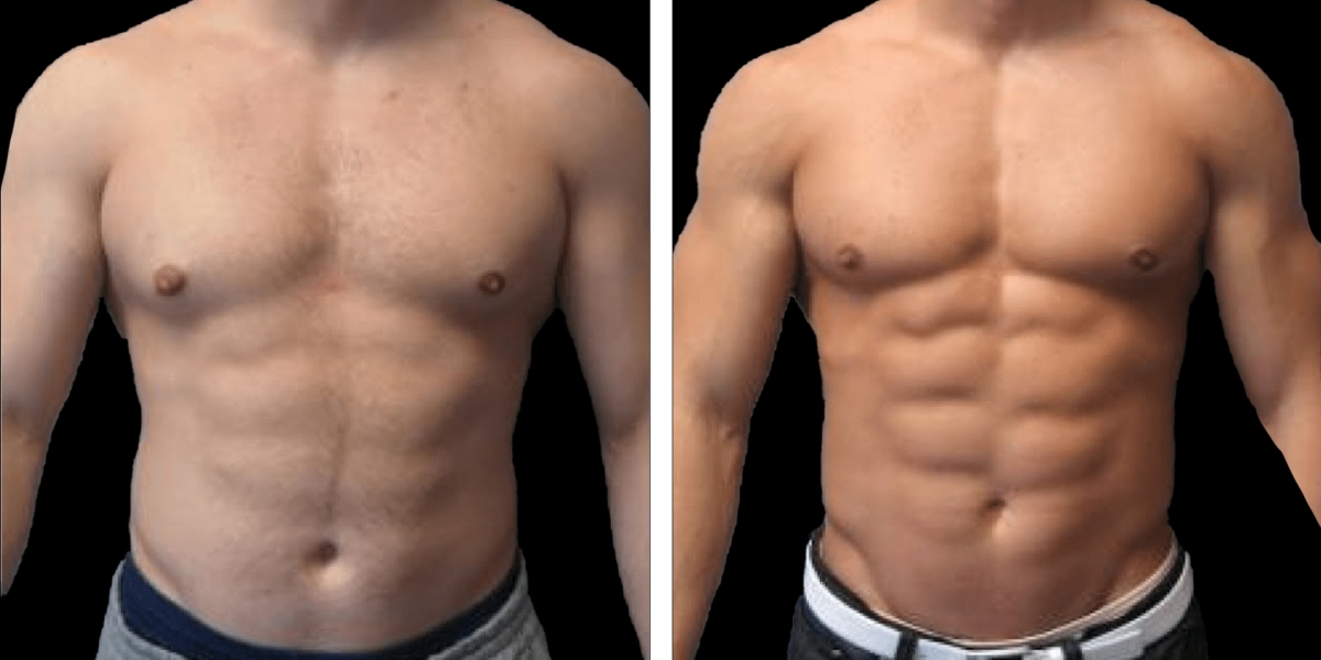 Clinics for Precision Body Sculpting and Six Pack Abs in Dubai