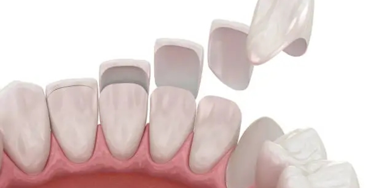Help Enhance Your Smile with Composite Veneers Sydney at Timeless Smiles Dental