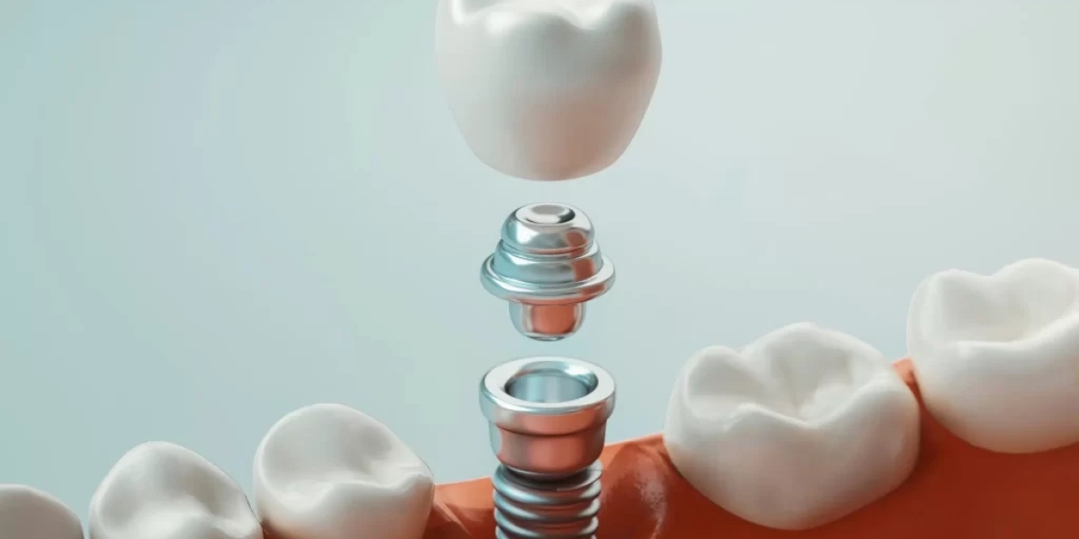 Possible Good Dental Implants Brisbane Care with Hashtag Dentist