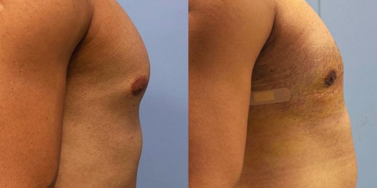 Why Is Experience Important for Gynecomastia Surgery Islamabad?