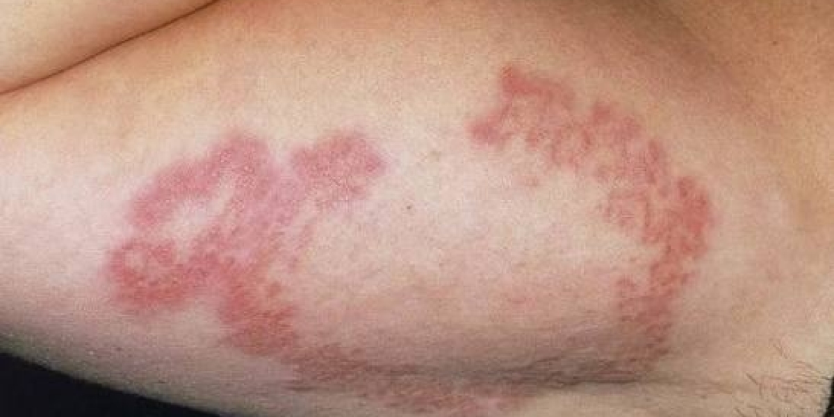 Granuloma Annulare Herbal Remedies: A Practical Buyer’s Guide