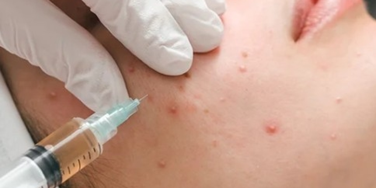 Acne Treatment In Dubai for Clearer, Healthier-Looking Skin