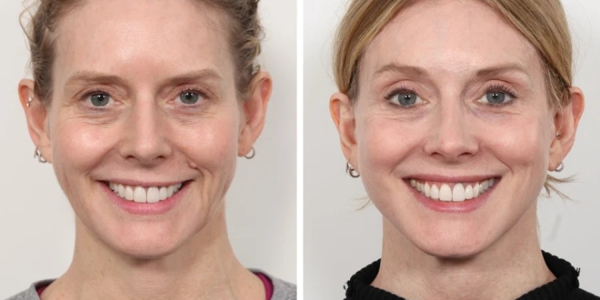Best Doctors in Dubai for Customized Thread Lift Results