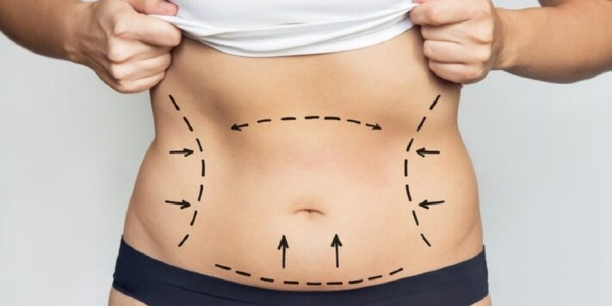 Best Liposuction Surgeon in Dubai: Understanding Modern Body Sculpting Techniques