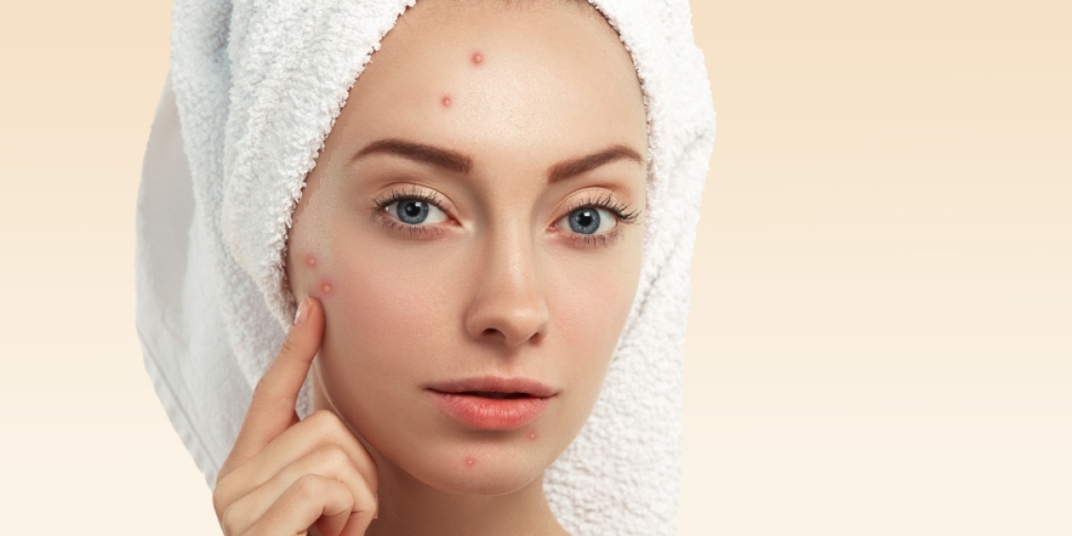 Acne Treatment in Manchester: Solutions for Clearer and Healthier-Looking Skin