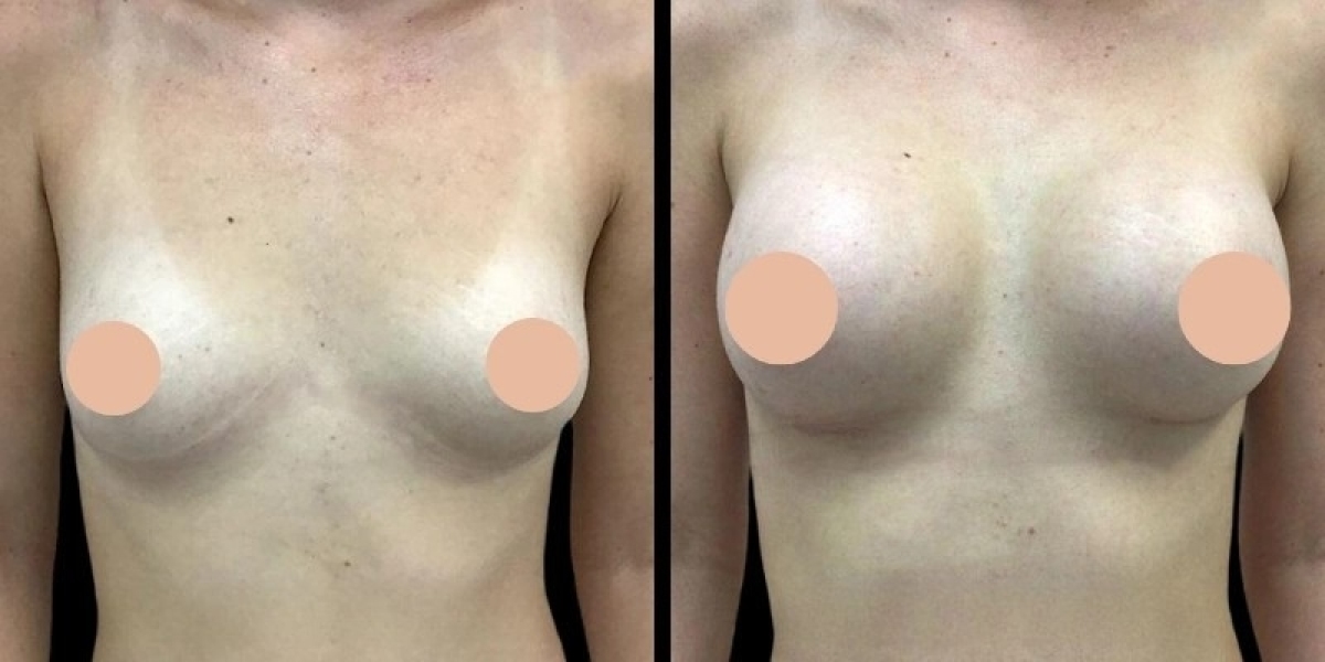 Breast Augmentation in Dubai: Implant Types and Their Benefits