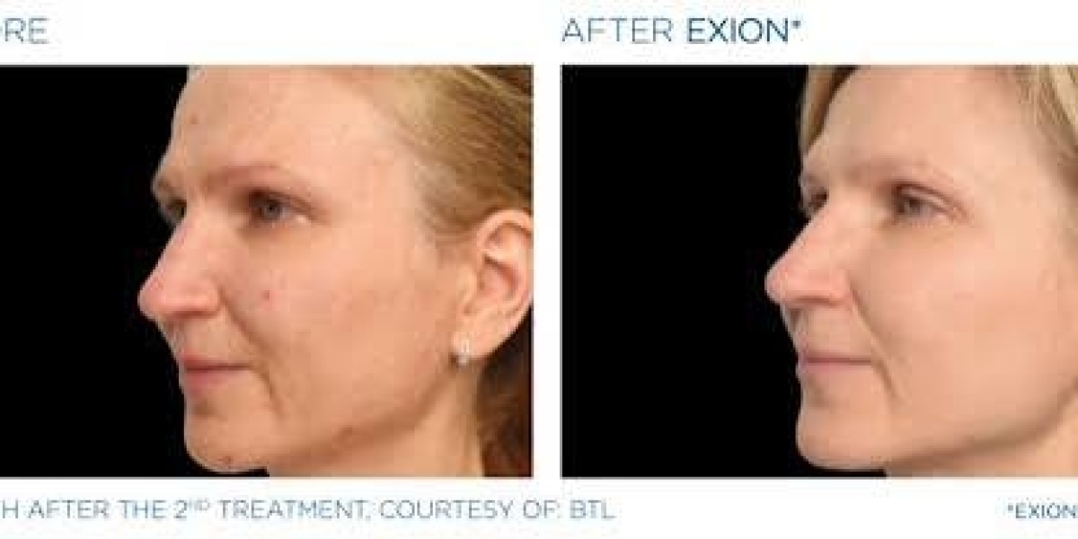 Exion Skin Tightening: What Should You Know?