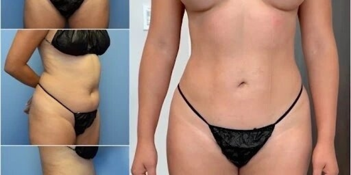 Best Body Contouring Surgeon in Dubai for Natural-Looking Body Contours