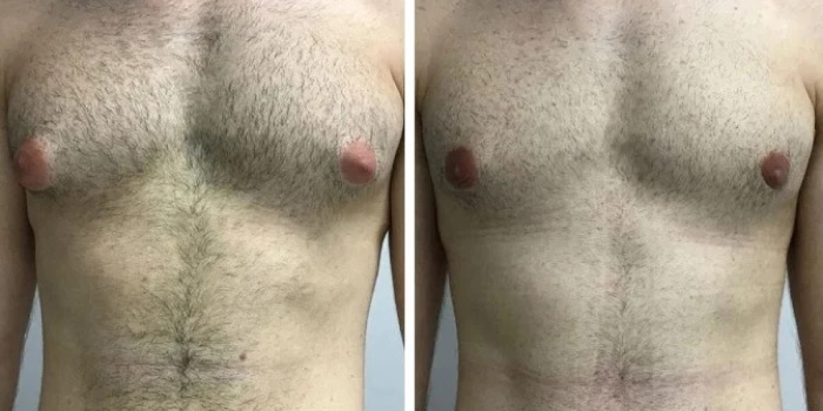 Exploring Non-Surgical Approaches for Gynecomastia in Dubai