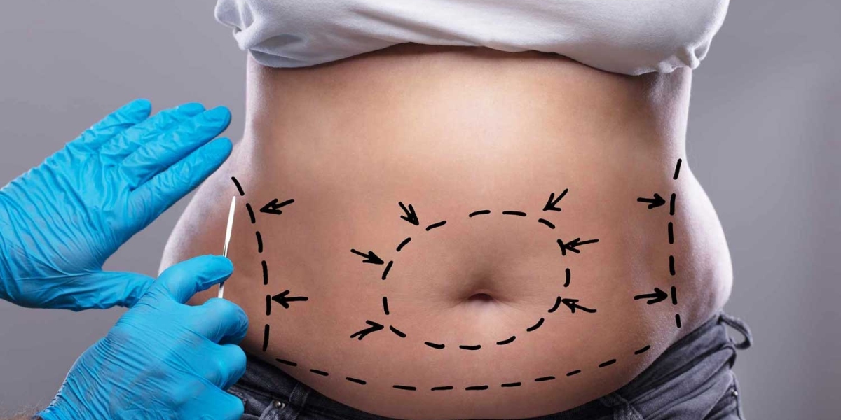 Preparing for Tummy Tuck Surgery in Dubai: A Patient Checklist