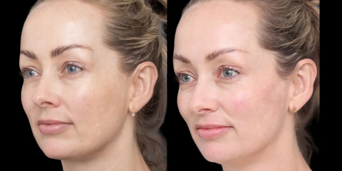 Aesthetic Experts for Cheek Fillers Treatments in Dubai