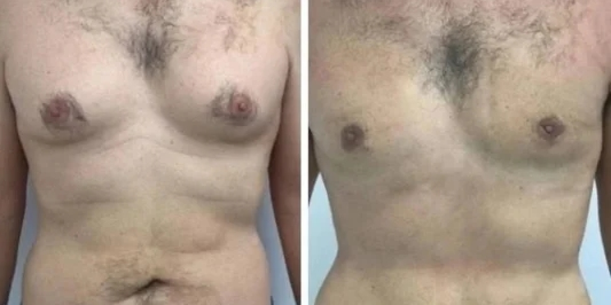 Gynecomastia in Dubai: From Chest Concerns to Corrective Care