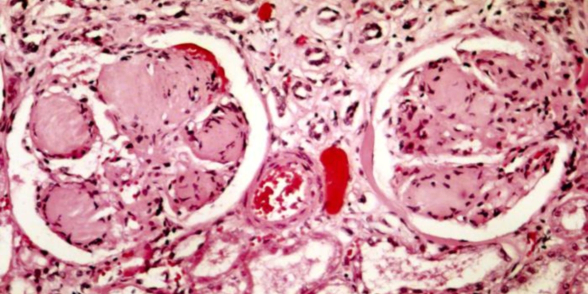 What Are APOL1 Treatment, C1q Nephropathy Treatment, and C3 Glomerulopathy Treatment Options?