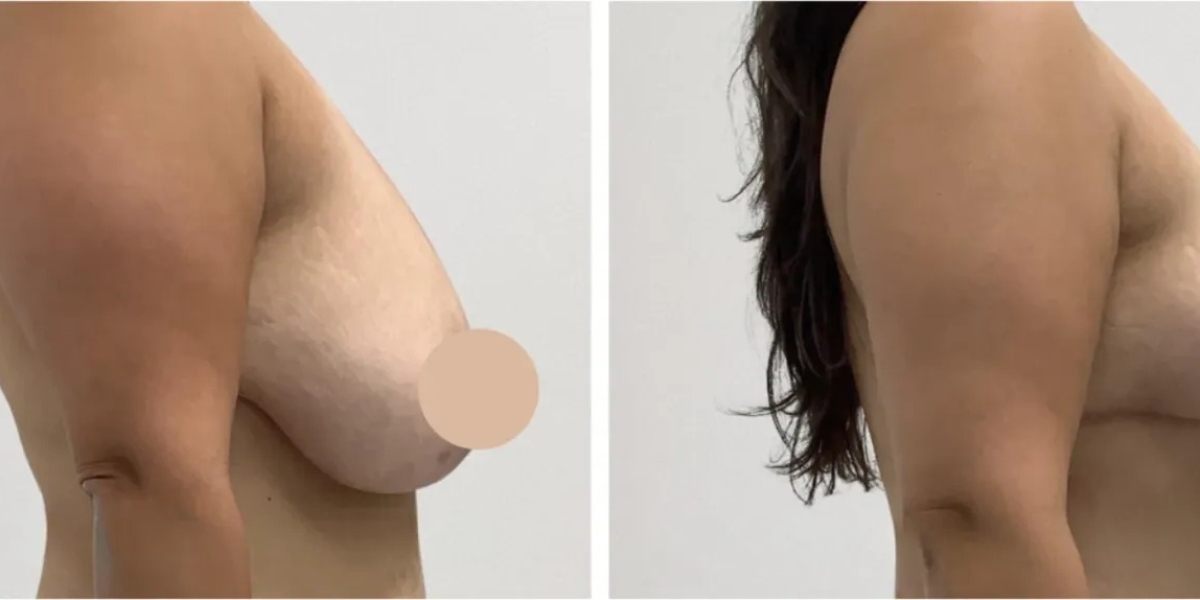 Best Breast Lift Surgeons in Dubai for Long-Lasting Breast Contours