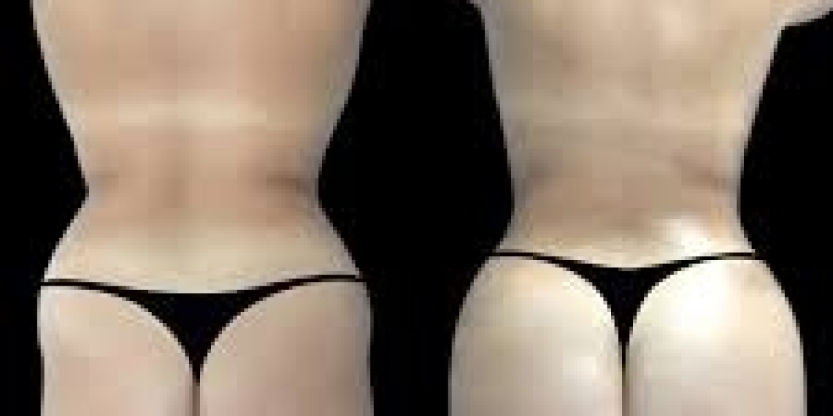 When to Contact the Best Butt fat transfer Surgeons in dubai During Recovery